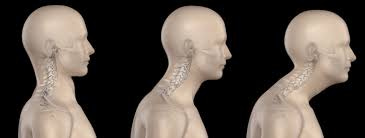 Do You Have Forward Head Posture ...