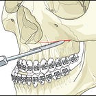 5.4 MARPE Surgical Assists - From Least to Most Invasive