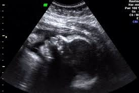 30 weeks ultrasound profile | Kristin | Flickr
