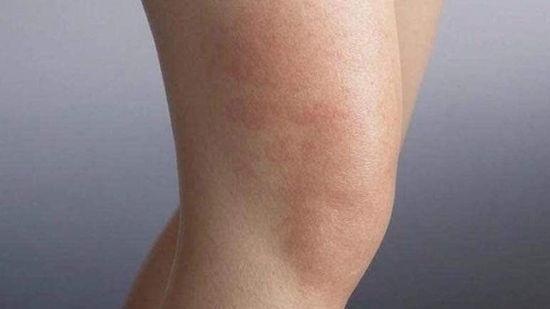 toasted skin syndrome