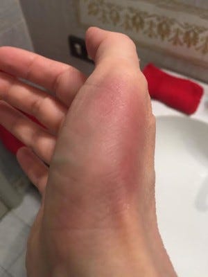 bruised thumb bruised thumb