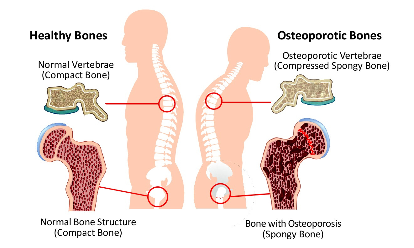 May is Osteoporosis & Prevention Month / Chiro & Sports Med