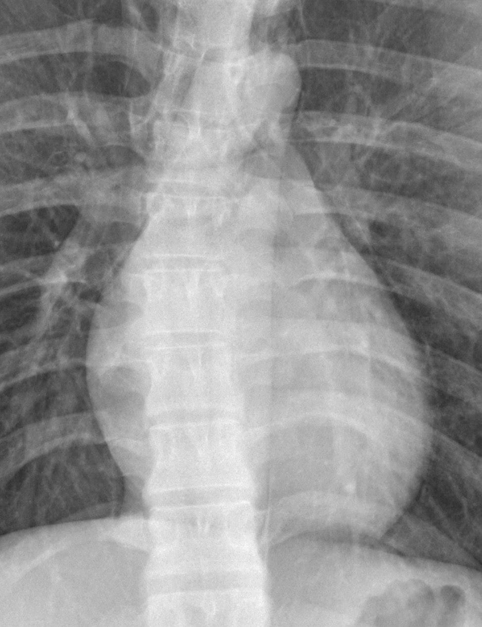 A chest x-ray of a person
Description automatically generated