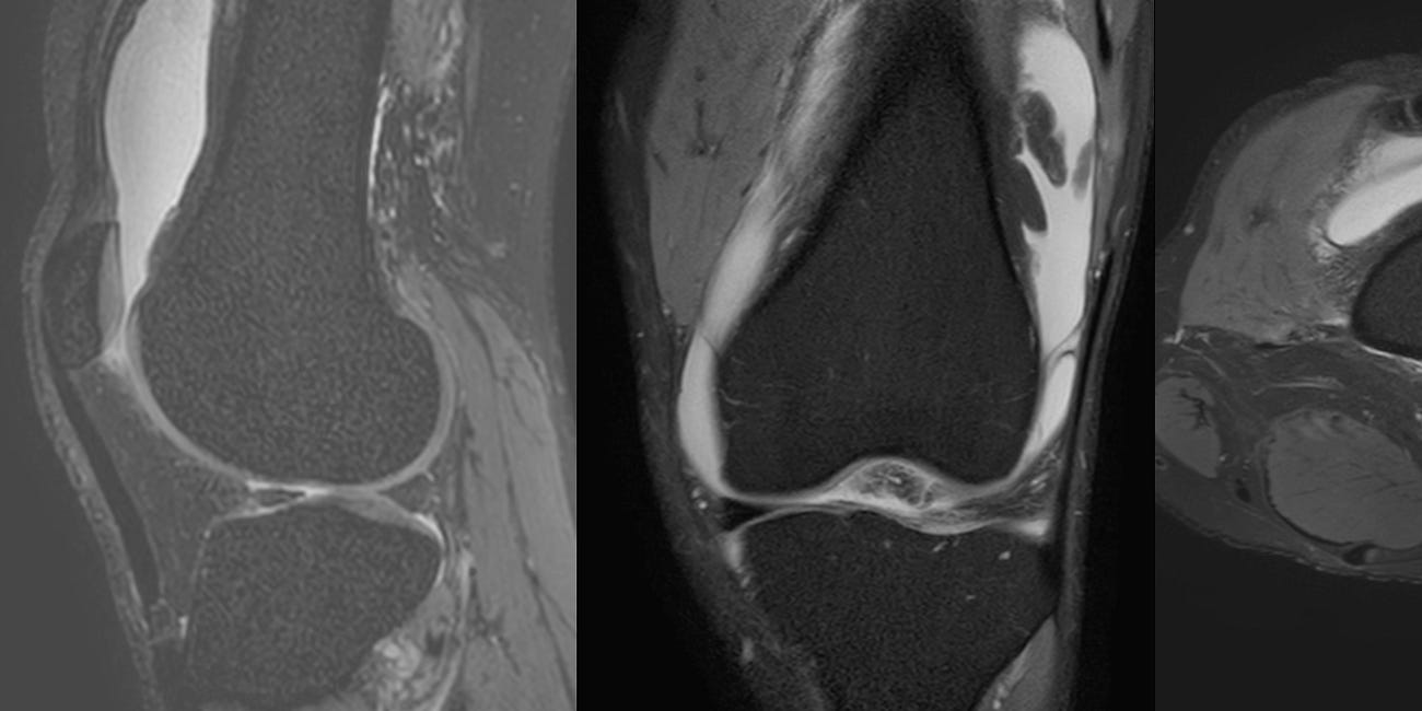 Case 71 - Fronds with Benefits in the Synovium