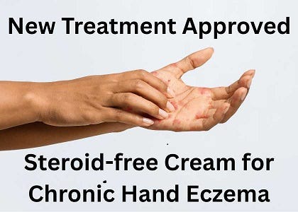 new treatment approved for hand eczema - cream - steroid free
