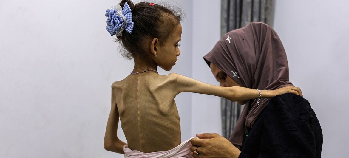 A severely malnourished girl in Gaza. Aid teams have repeatedly called for Israel to allow much more aid to enter Gaza to prevent the ongoing humanitarian catastrophe.