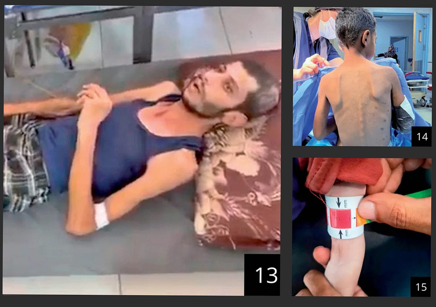 13. A 30-year-old man photographed about a week ago at Nasser Hospital by a UN staff member. 14. An 11-year-old boy photographed at the end of July at Nasser Hospital by Dr. Hussain. Not known to have preexisting illnesses. 15. A boy undergoing an examination at a medical center in the southern Gaza Strip. Photographed this week. 13. A 30-year-old man photographed about a week ago at Nasser Hospital by a UN staff member. 14. An 11-year-old boy photographed at the end of July at Nasser Hospital by Dr. Hussain. Not known to have preexisting illnesses. 15. A boy undergoing an examination at a medical center in the southern Gaza Strip. Photographed this week.