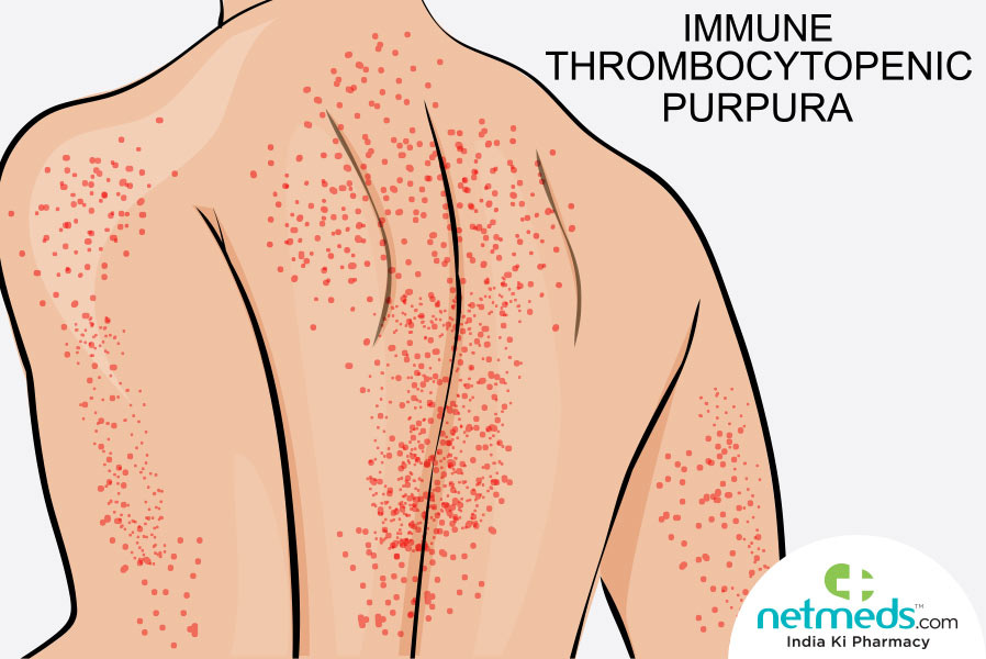 Immune Thrombocytopenia: Causes, Symptoms And Treatment