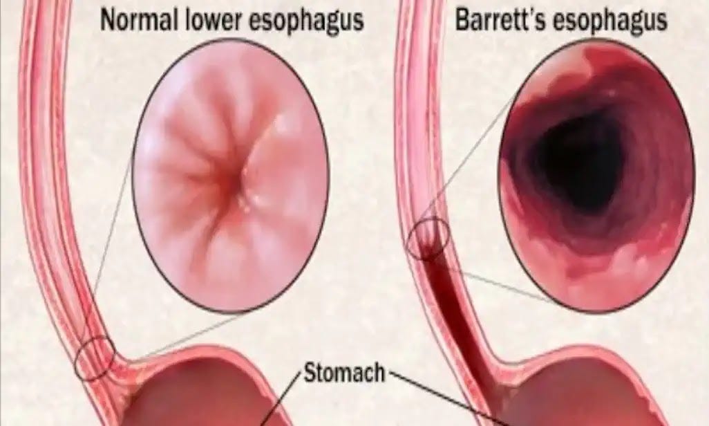 Illustration of a healthy esophagus compared to an esophagus with Barrett's changes