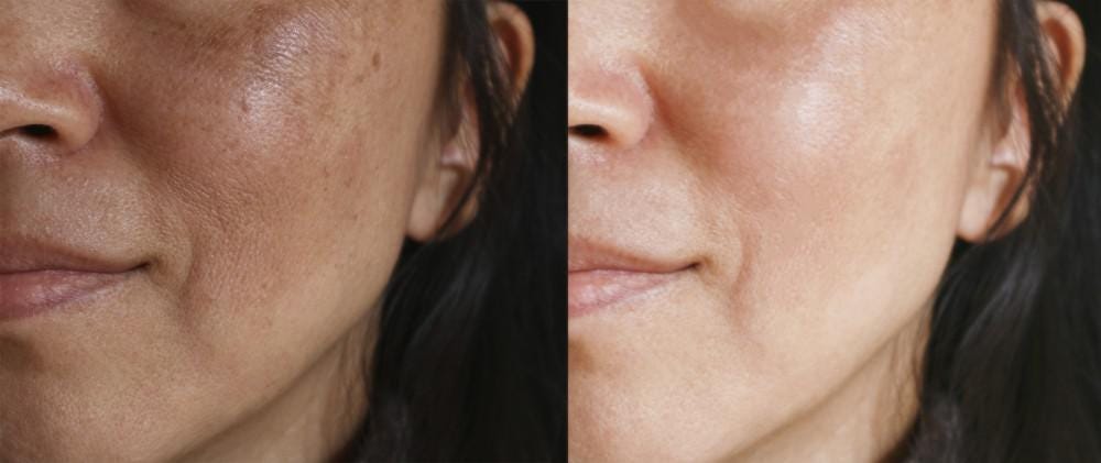 prp, plasma rico em plaquetas, melasma