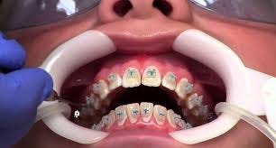 Process of Getting Braces: | Getting ...