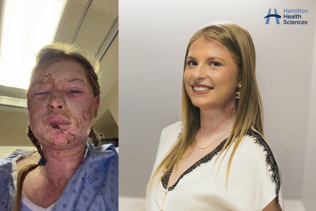 Western University student Kaitlin Jeffrey, 18, received an innovative treatment to help her heal from severe burns.
