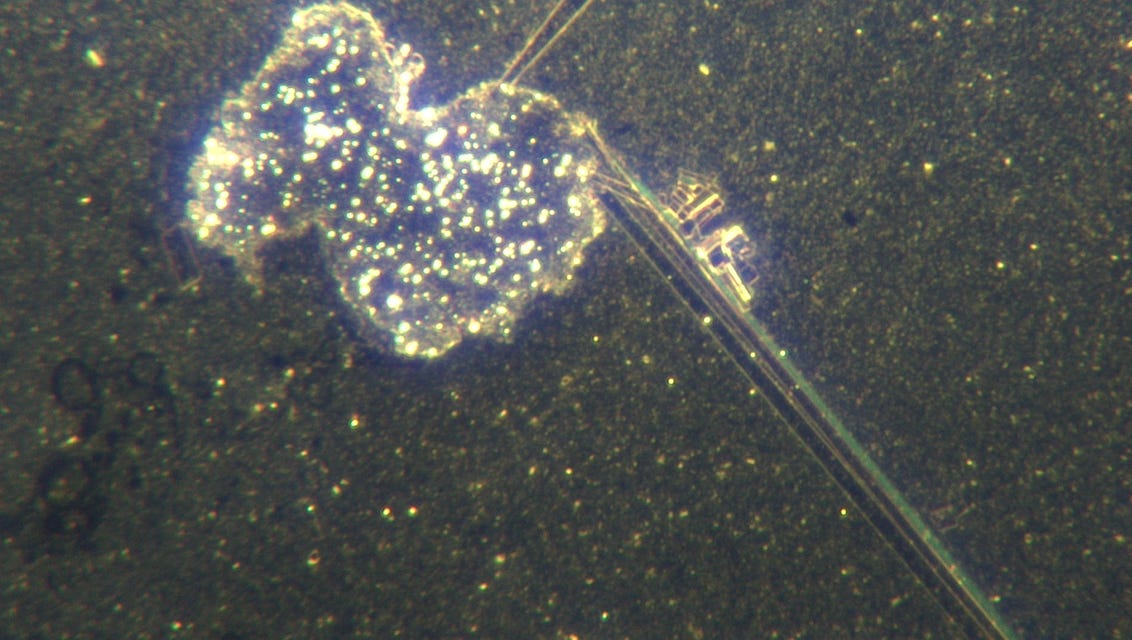 Human Blood Destroyed For Nanotechnology Self Assembly - Forming Rubbery Clots And Creating Microchips - Darkfield Microscopy COVID19 Unvaccinated Blood - The Platform For AI Extermination