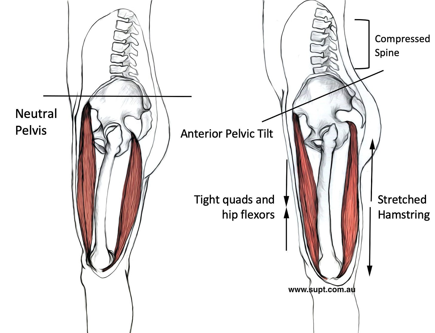 What is an 'Anterior Pelvic Tilt' and How to Correct it. — BodyWork What is an 'Anterior Pelvic Tilt' and How to Correct it. — BodyWork
