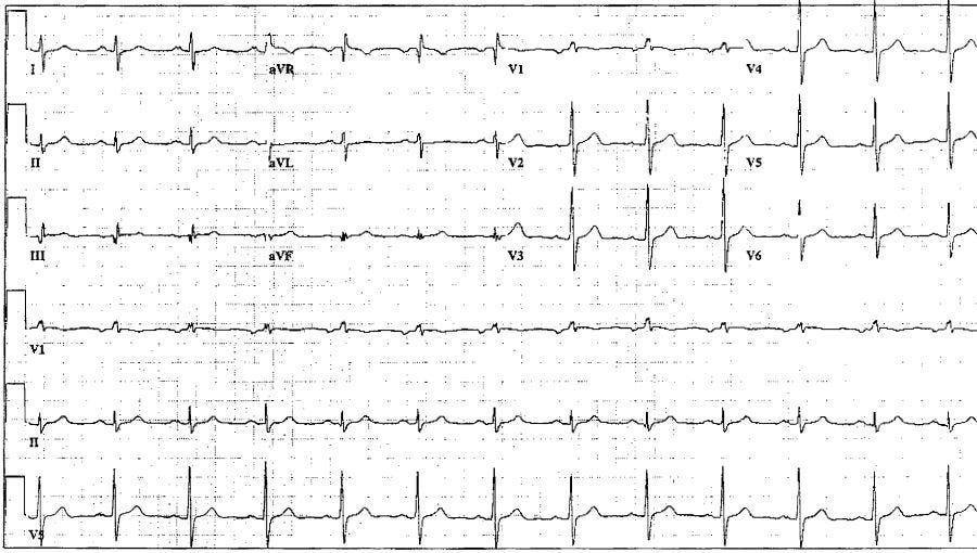 Heart Expelled Through Chest Wall [Sternotomy Disaster]