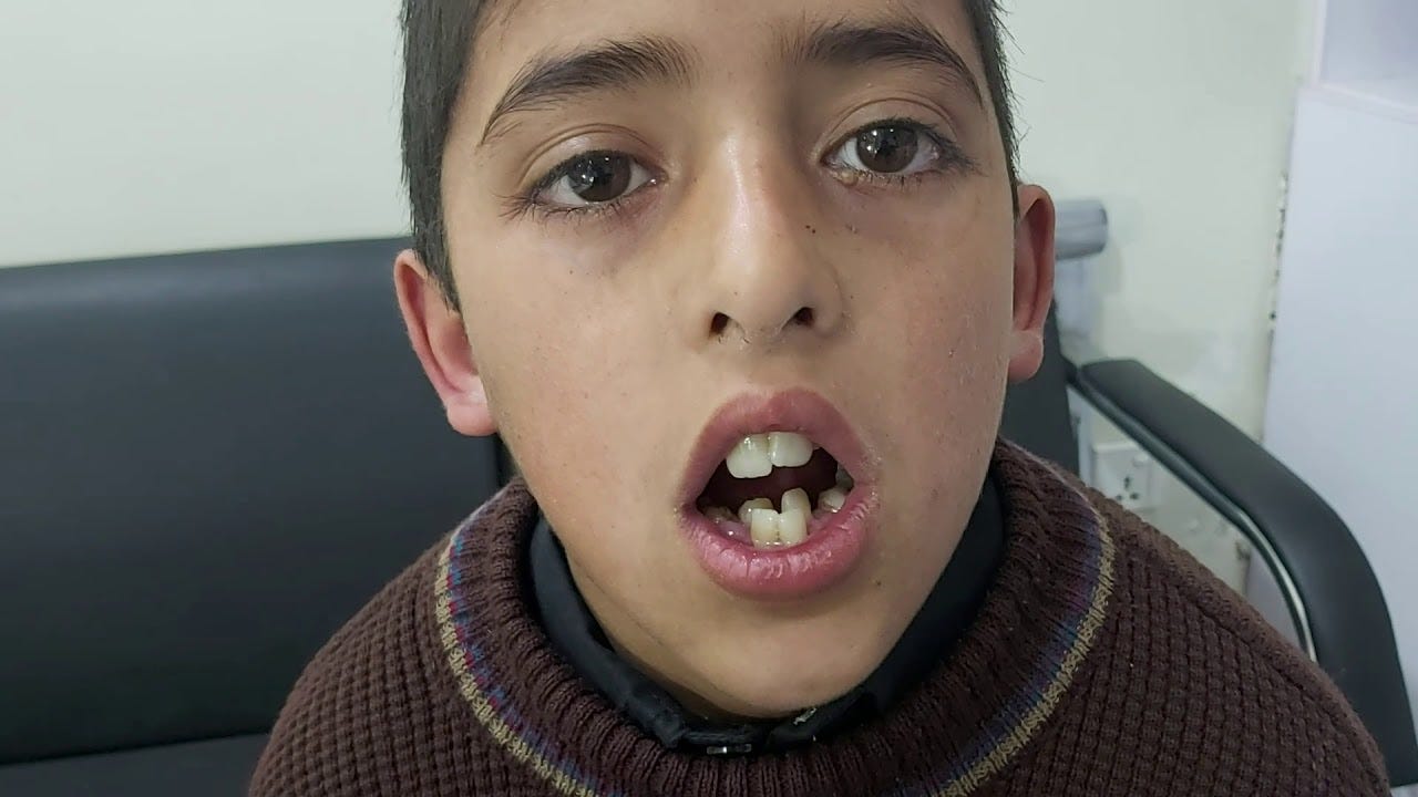 Enlarged Adenoids & Adenoid facies
