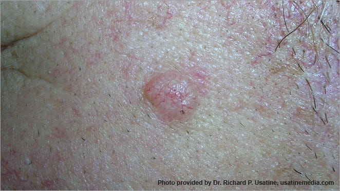 Skin Cancer Pictures | Skin Cancer Images | What Does Skin Cancer Look Like? | American Cancer Society Skin Cancer Pictures | Skin Cancer Images | What Does Skin Cancer Look Like? | American Cancer Society