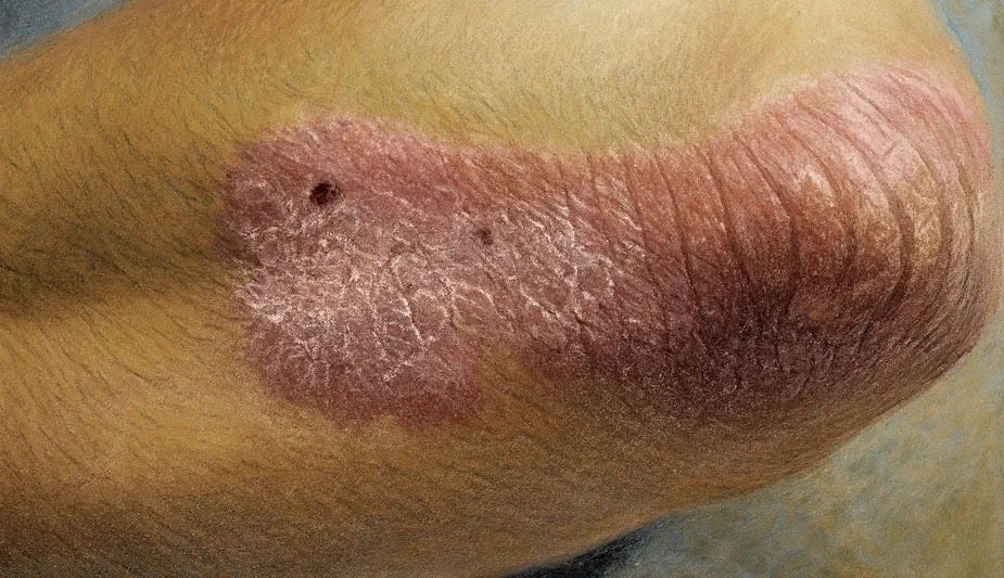 Image of Psoriasis on the Elbow Close-up of plaque psoriasis on a researcher's elbow, illustrating silvery scales and inflammation.