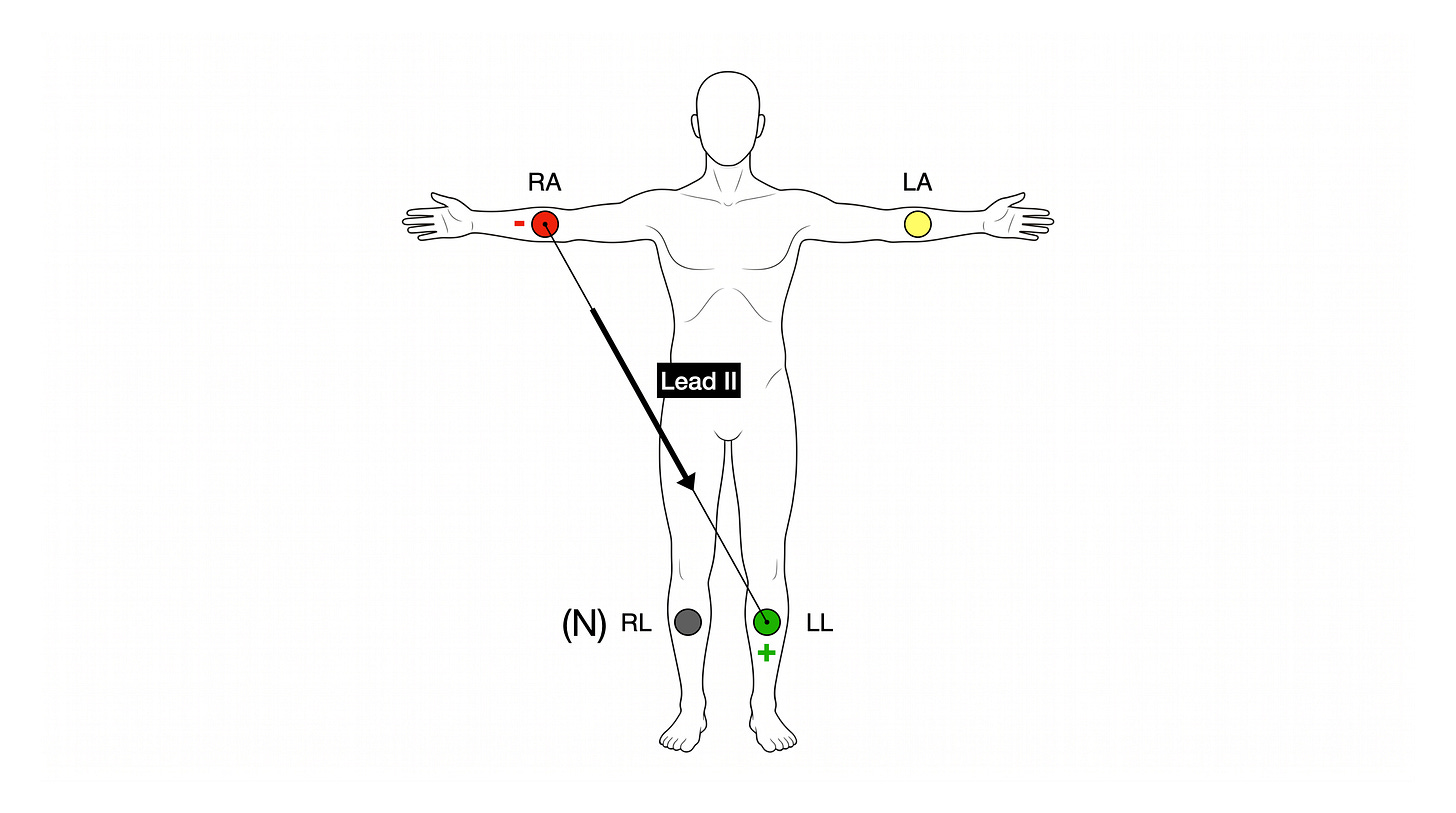 Front-view torso with limb electrodes labelled RA (red), LA (yellow), LL (green), and N RL (black). A black arrow runs diagonally from the RA electrode down to the LL electrode and is labelled Lead II. The LL electrode is marked (+) and the RA electrode (−).