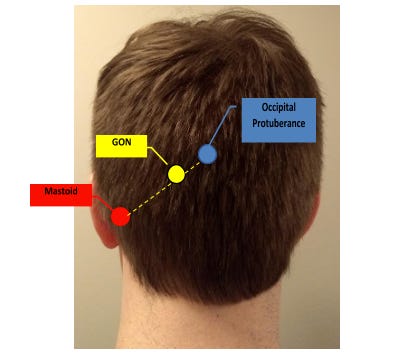 Figure 2: Representative schematic to aid in locating the greater occipital nerve, using method 1(b) as described above.