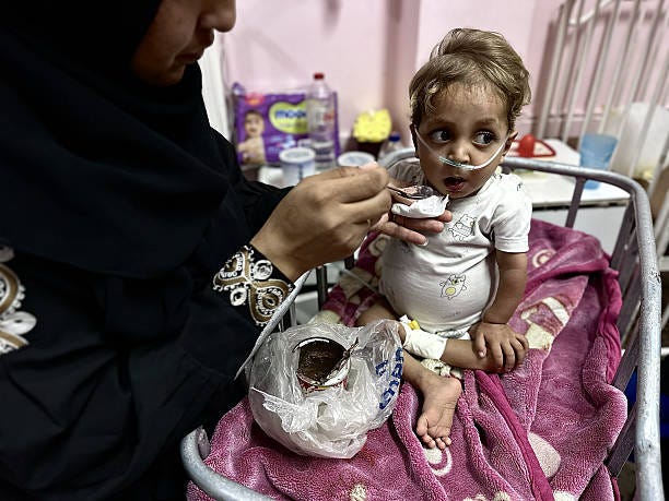 Three-year-old Hassan Barbakh, one of the hundreds of children diagnosed with malnutrition, is being treated with limited facilities at Nasser...