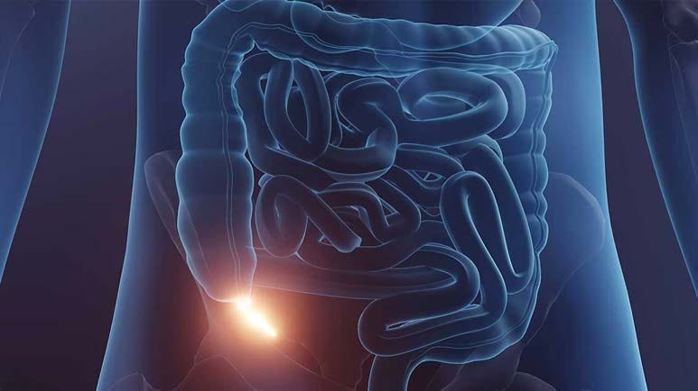 Appendix Cancer Is on the Rise Among Younger Generations