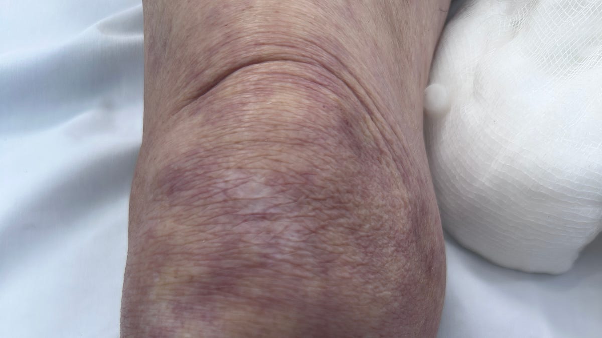 [Sepse e Choque] Mottling Score: quando a pele revela mais do que o ...