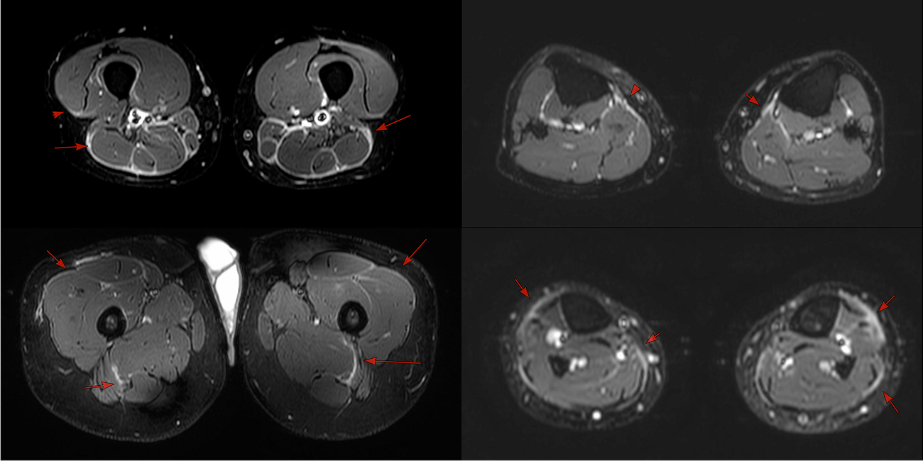 Case 62: The Symmetric Fascial Edema Pattern of Dermatomyositis