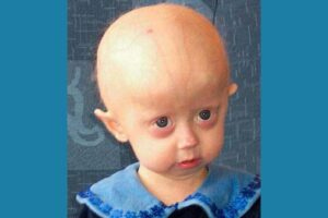 A young girl with progeria Image credit: CC BY 2.5 via Wikimedia Commons
