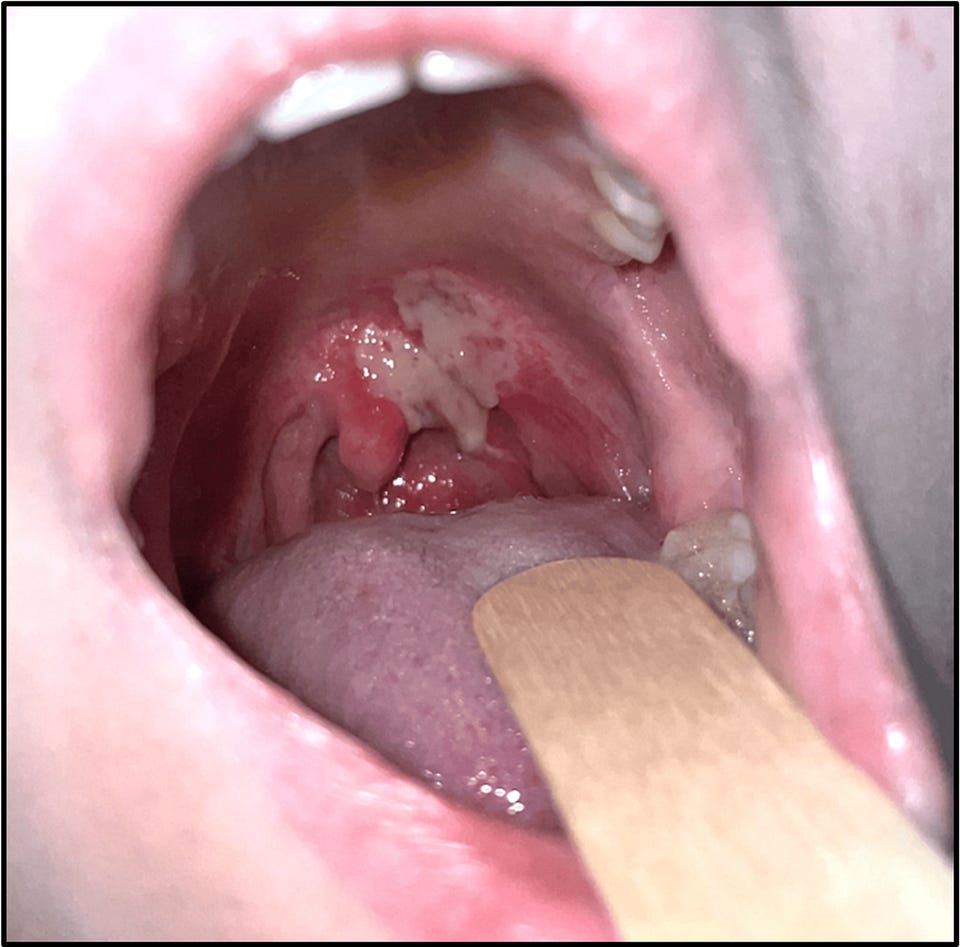 Soft Palate and Uvula Thermal Burn Injury in an Adolescent Following Recreational Inhalation of Nitrous Oxide | Cureus