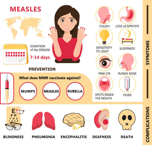 Mazelen Infographic Concept Vector Besmette Mens Met Papels Op De Huid  Rubeola Symptomen En Complicaties Illustratie Stockvectorkunst en meer  beelden van Mazelen - iStock
