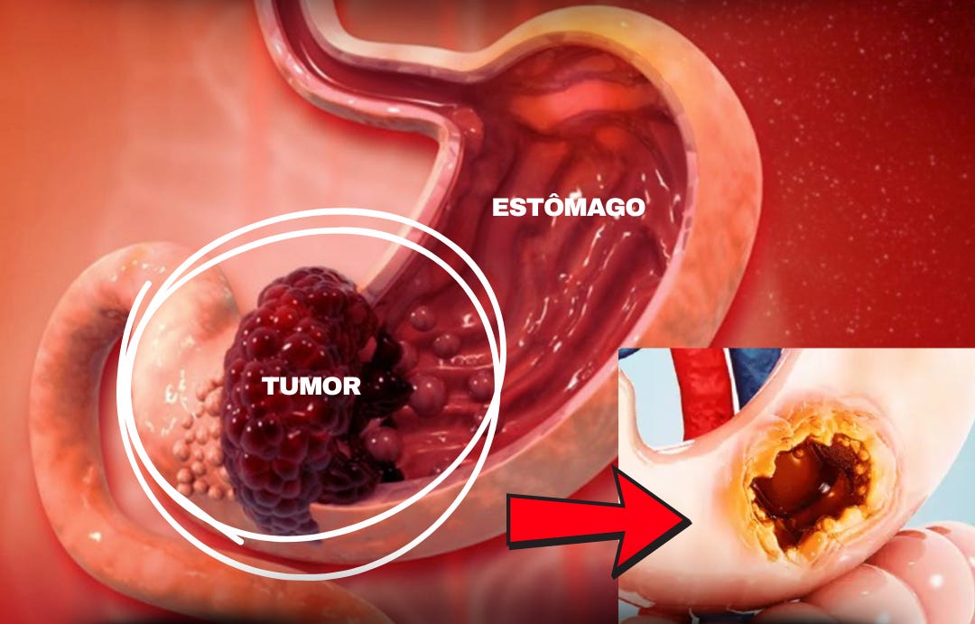 10 principais sintomas de câncer no estômago