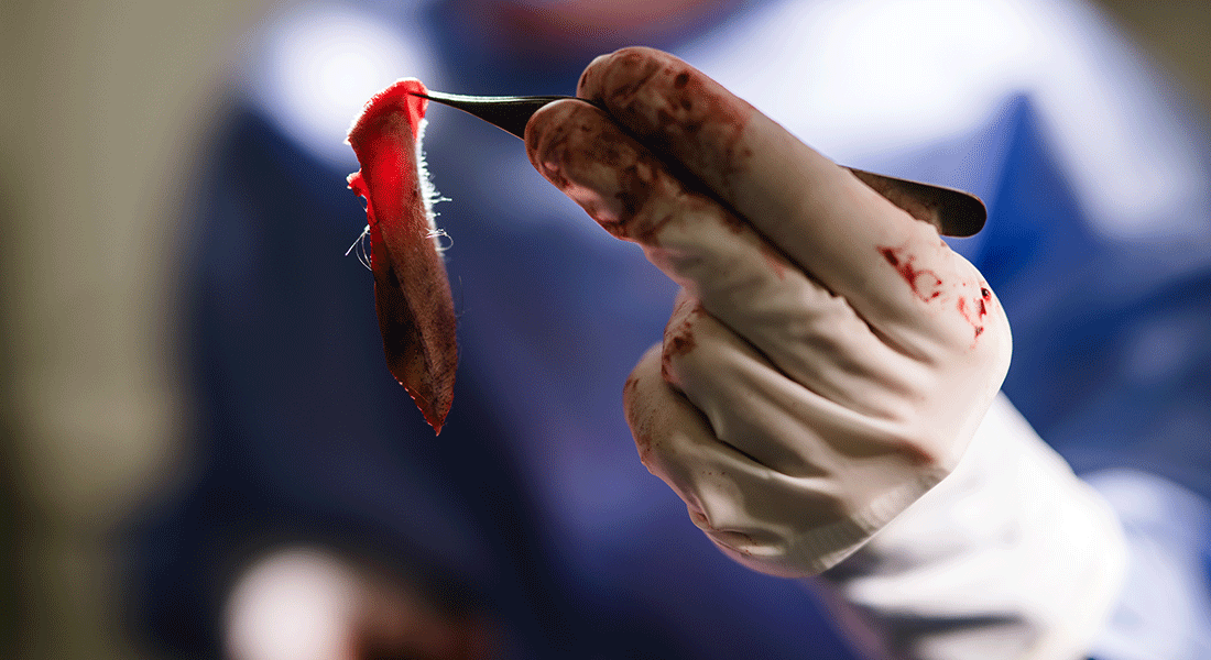 [a slice of flesh from my face held in tweezers by the surgeon]