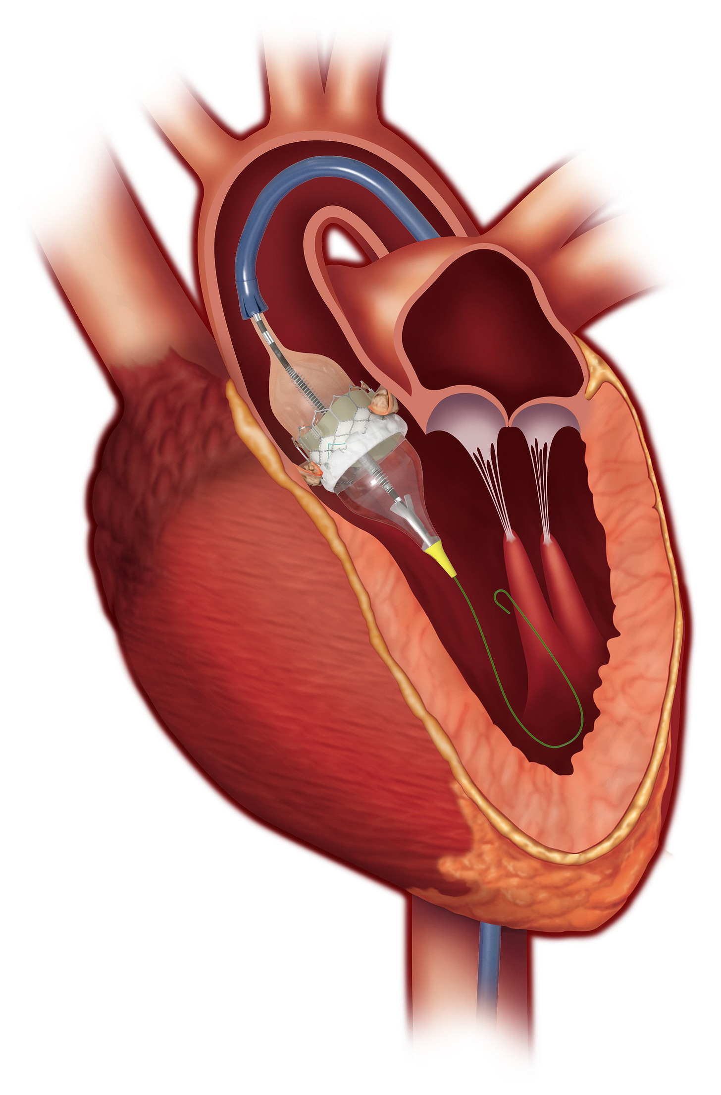 FDA Clears Aortic, Mitral Valve-In-Valve Procedures for Sapien 3 TAVR Valve  | DAIC