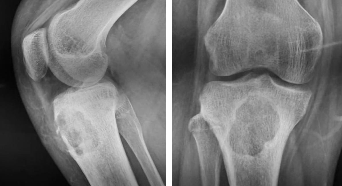 Case 29: Proximal Tibial Bump