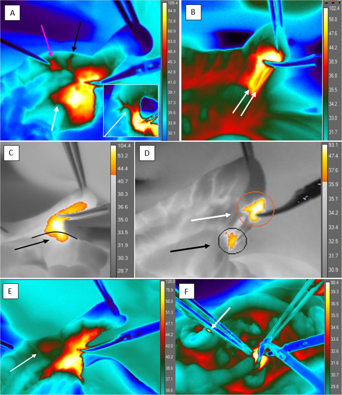 Thermal effects of monopolar electrosurgery detected by real-time infrared  thermography: an experimental appendectomy study | BMC Surgery | Full Text