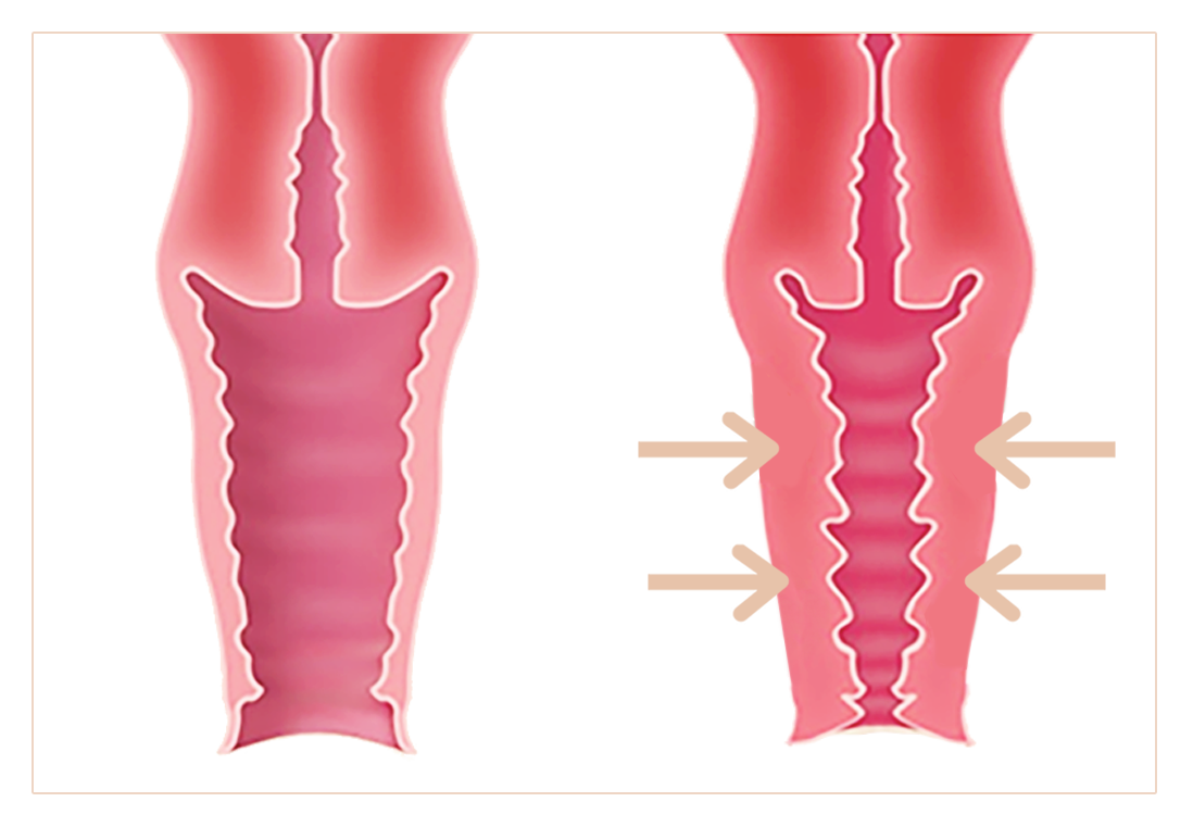 V tightening before and after