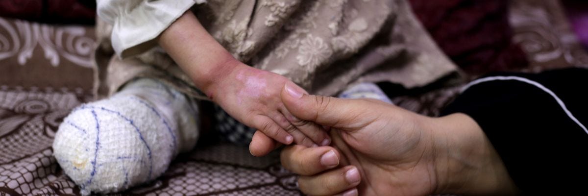 MIDEAST-GAZA-DEIR AL-BALAH-CHILD AMPUTEES