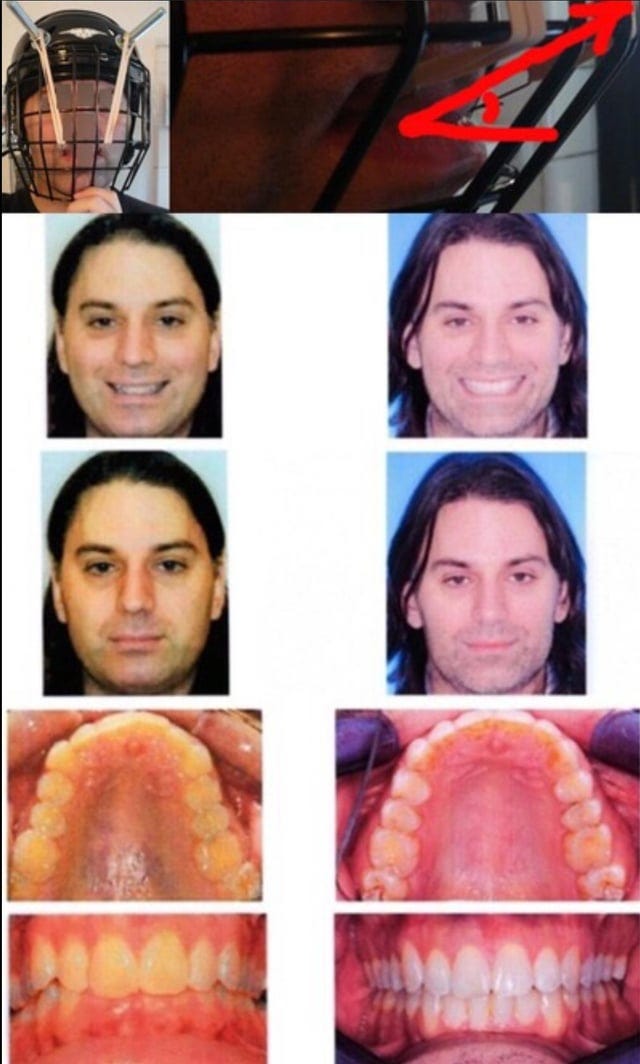 My official position on thumbpulling