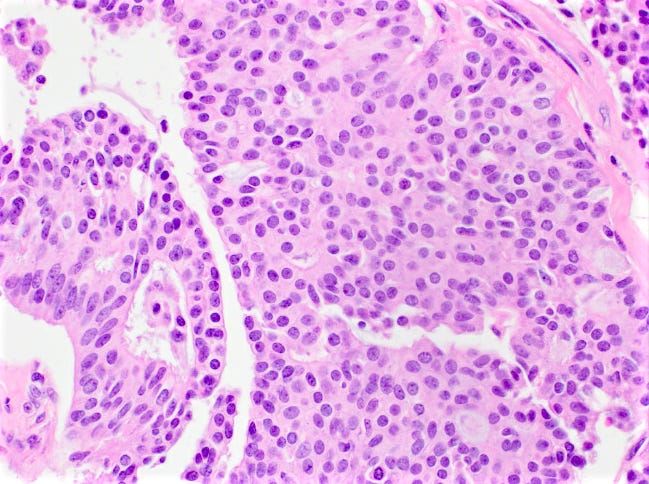 Neuroendocrine features Neuroendocrine features