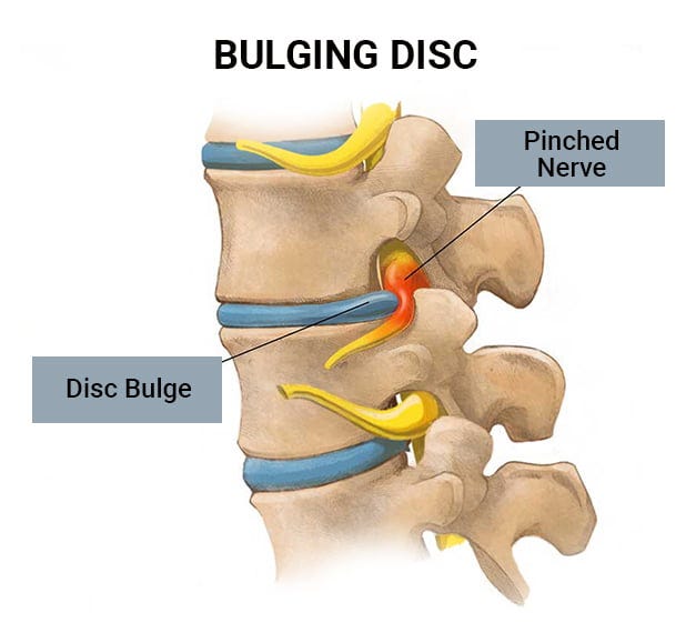Cervical Slipped Disc/Bulging Disc Doctors NJ & NYC