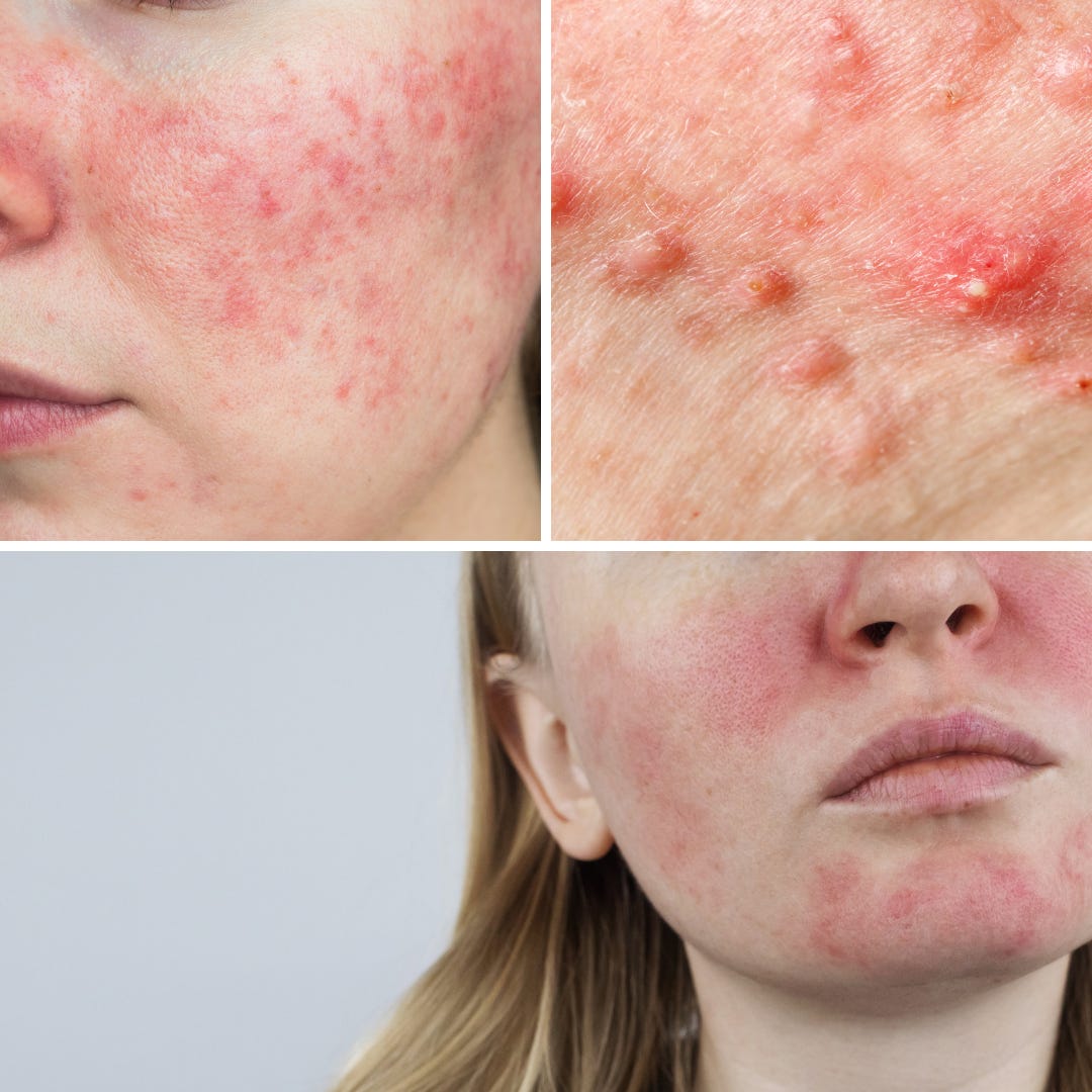 How To Reduce Redness, Irritation and Inflammation — Pure Emporium Skin &  Laser Clinic | Hereford