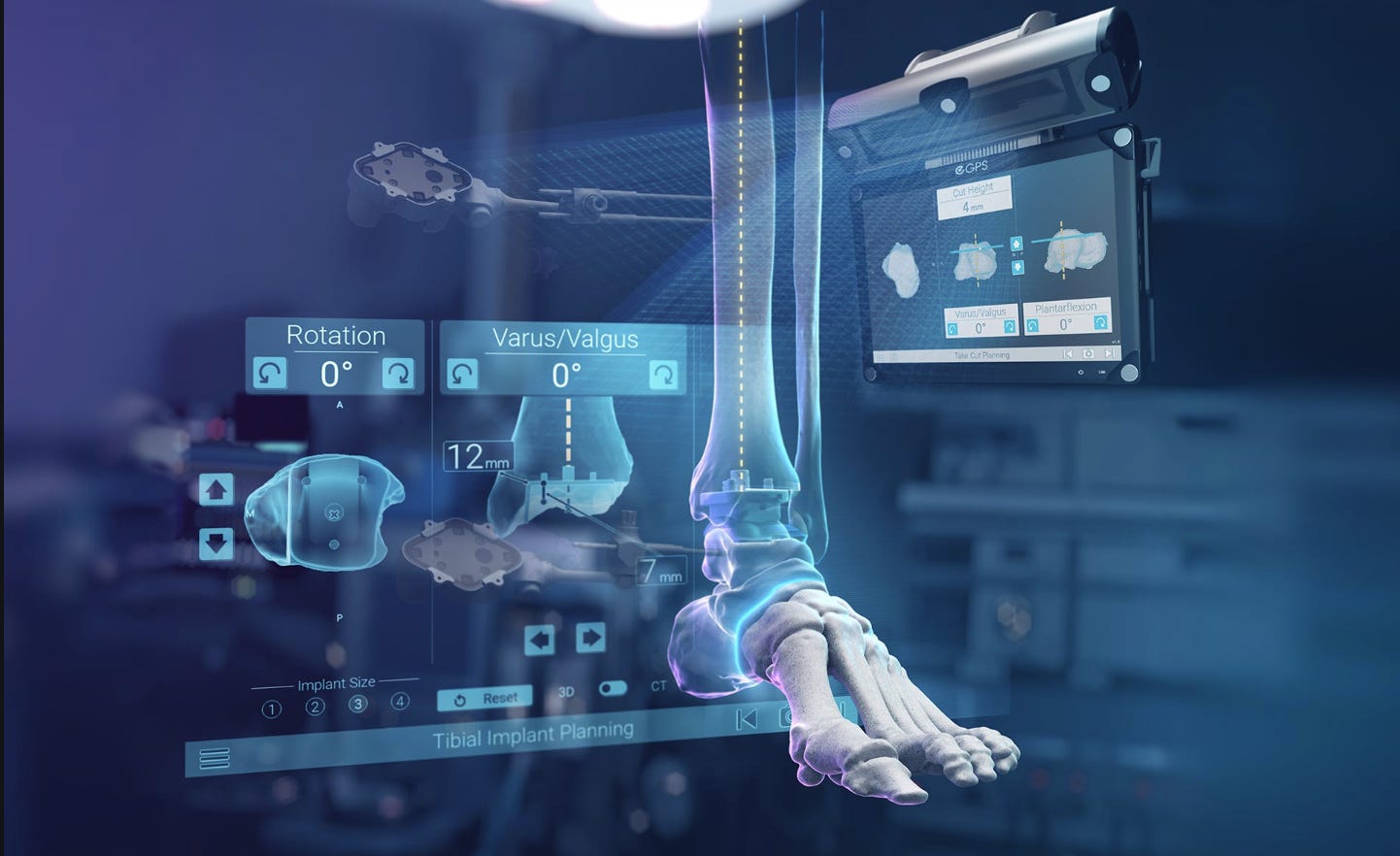 GPS Ankle – Navigation System for Total Ankle Arthroplasty