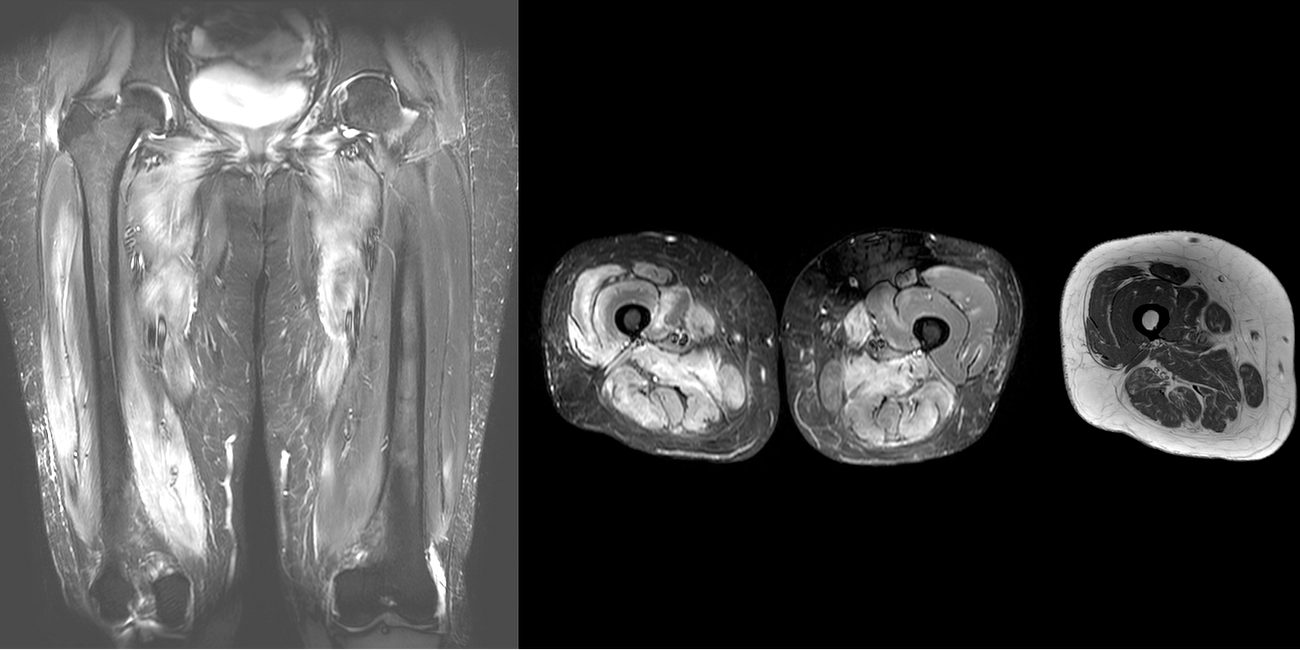 Case 64: The Foggy Pattern of Myositis