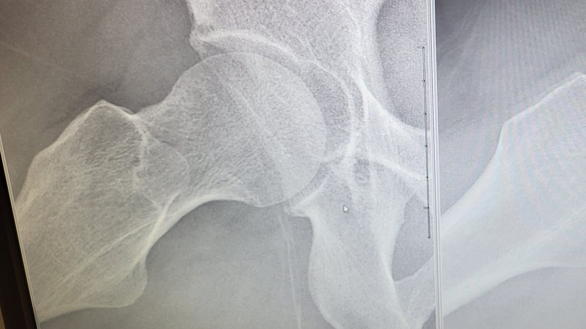 My Hip Before and After Surgery - Exulansic