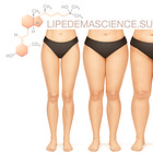 Low Vitamin D in Women with Lipedema
