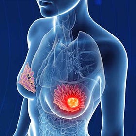 Case Report: Triple-Negative Breast Cancer Stage III, age 45, Female