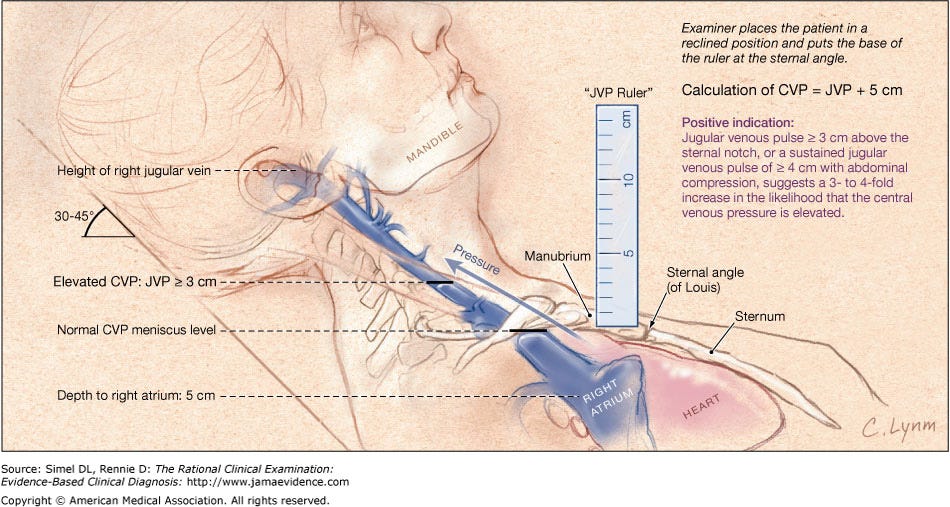 Jugular Venous Pressure Measurement Examiner places ... | GrepMed