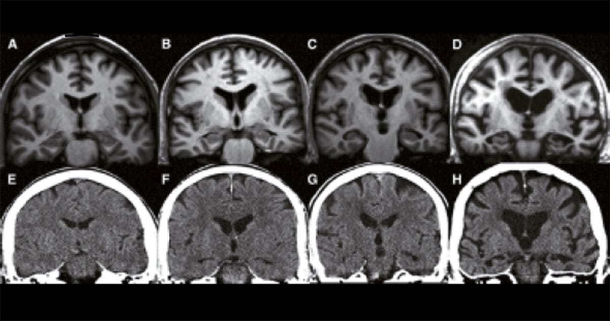 Oito fotografias de ressonâncias magnéticas ou tomografias computadorizadas do cérebro, identificadas pelas letras de A a H. Oito fotografias de ressonâncias magnéticas ou tomografias computadorizadas do cérebro, identificadas pelas letras de A a H.