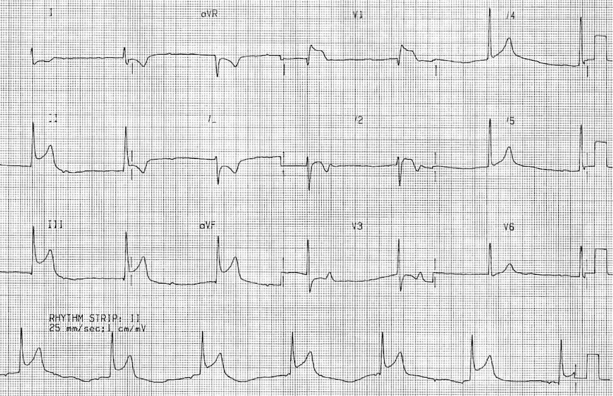 Inferior STEMI • LITFL • ECG Library Diagnosis